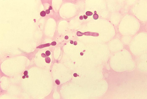 Nấm Malassezia được cho là có liên quan đến sự xuất hiện tình trạng viêm da dầu